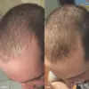 Revive7_Hair_Before_After_Male_2