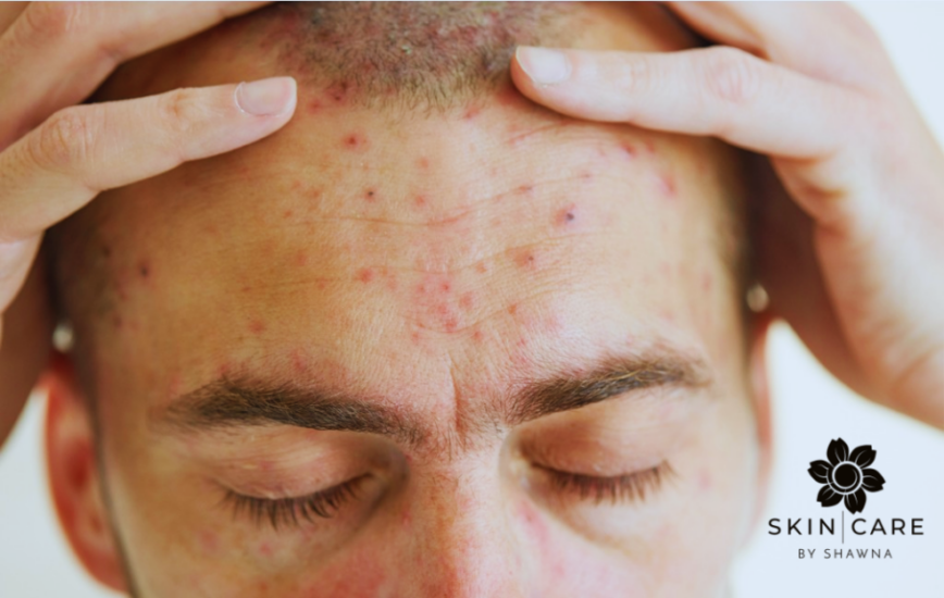 Adult Acne Skin Care by Shawna