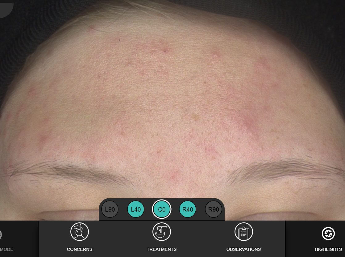 H_Square_after_2026_B Teen Acne after Skin Care by shawna