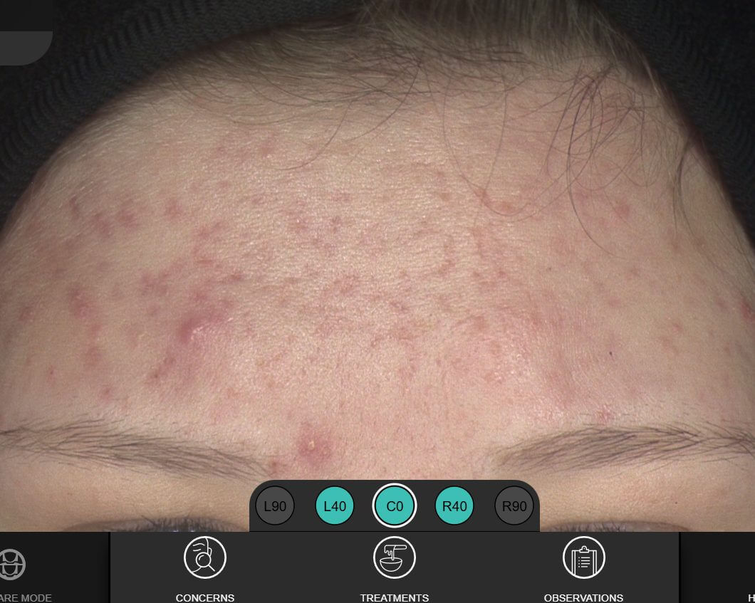 H_Square_before_2026_A Teen Acne before Skin Care by Shawna